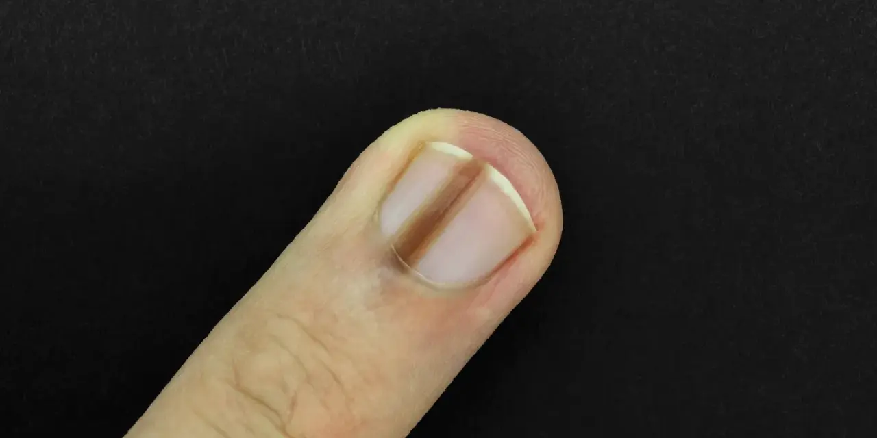 Un ongle de doigt présente une ligne verticale brune, un signe possible de carence en fer.