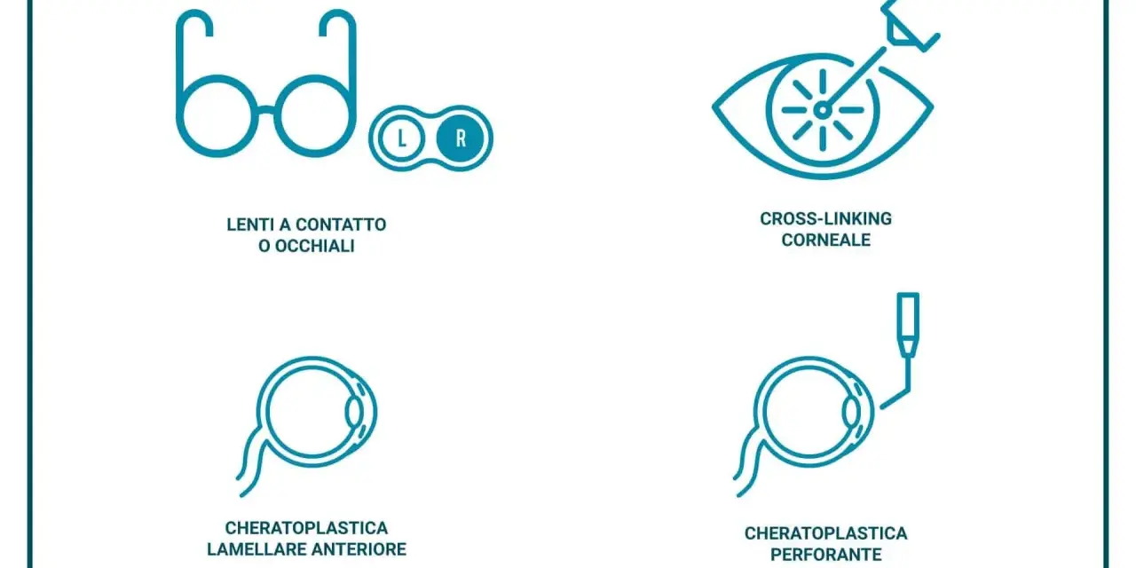 Illustrazione delle cure per il cheratocono: lenti, cross-linking, cheratoplastica lamellare e perforante. Queste opzioni aiutano a gestire le conseguenze del cheratocono.