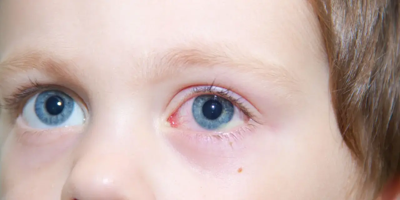 Occhio di bambino con congiuntivite, l'occhio rosso e irritato, con piccole vene visibili.