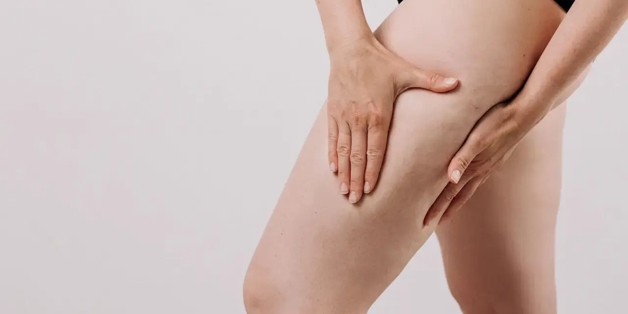 Une femme touche sa cuisse, montrant les capitons de la cellulite.