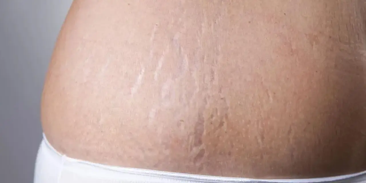 Widoczne rozstępy na brzuchu, które można zredukować zabiegiem dermapen.