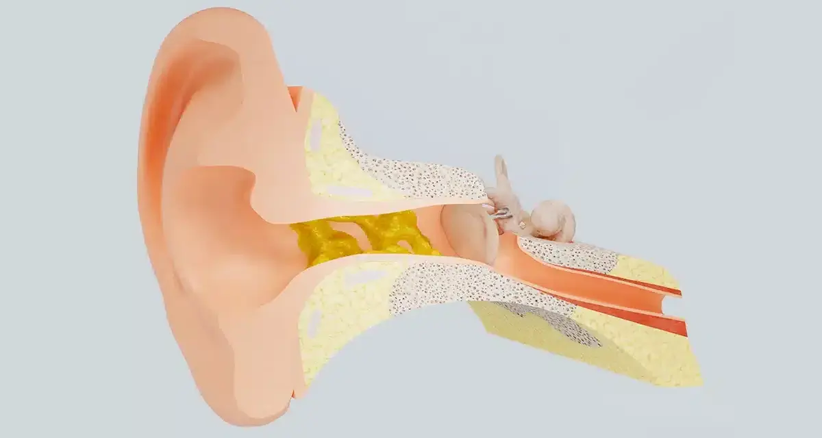 Sezione anatomica dell'orecchio con cerume giallo che blocca il condotto uditivo, impedendo all'acqua nelle orecchie di uscire.