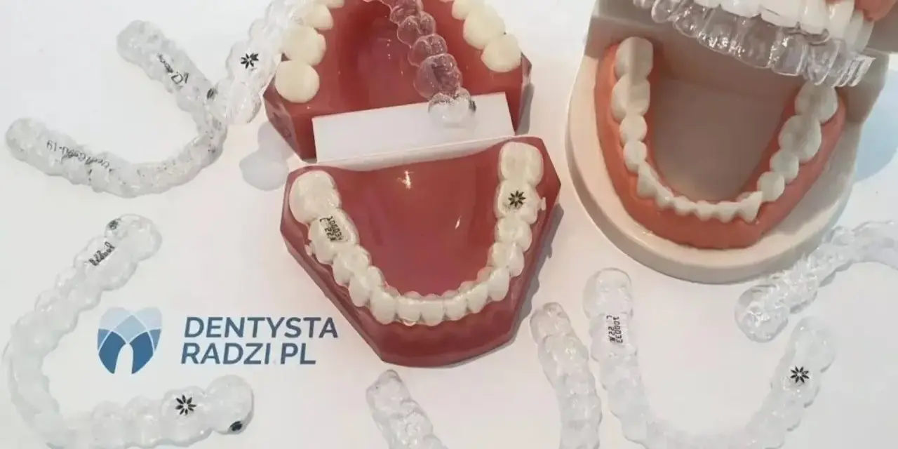 Modele szczęk z nakładkami ortodontycznymi. Wiele przezroczystych nakładek, czyli clear aligner, leży wokół modeli.