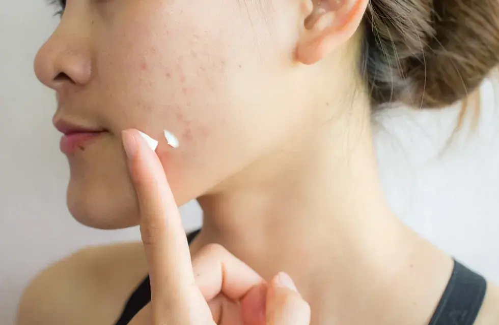 Pasta do zębów na pryszcze? Dermatolodzy: To mit i szkoda dla skóry