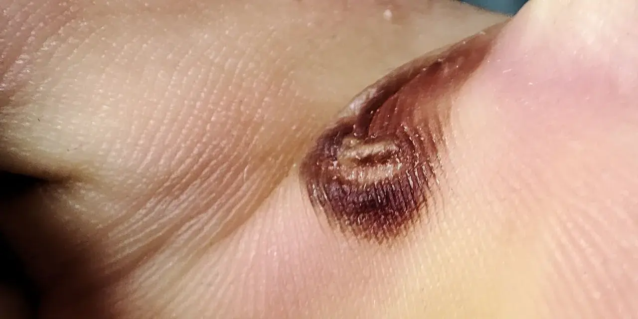 Nahaufnahme einer verbrannten Hautstelle, die wie eine Wasserblase aussieht. Die Behandlung dieser Verletzung ist wichtig.