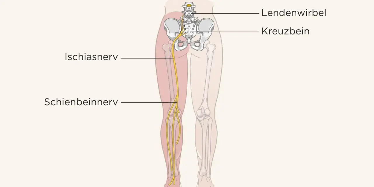 Illustration des Ischiasnervs, der vom Kreuzbein bis ins Bein verläuft. Ein Geheimtipp bei Ischias: Verständnis der Anatomie.