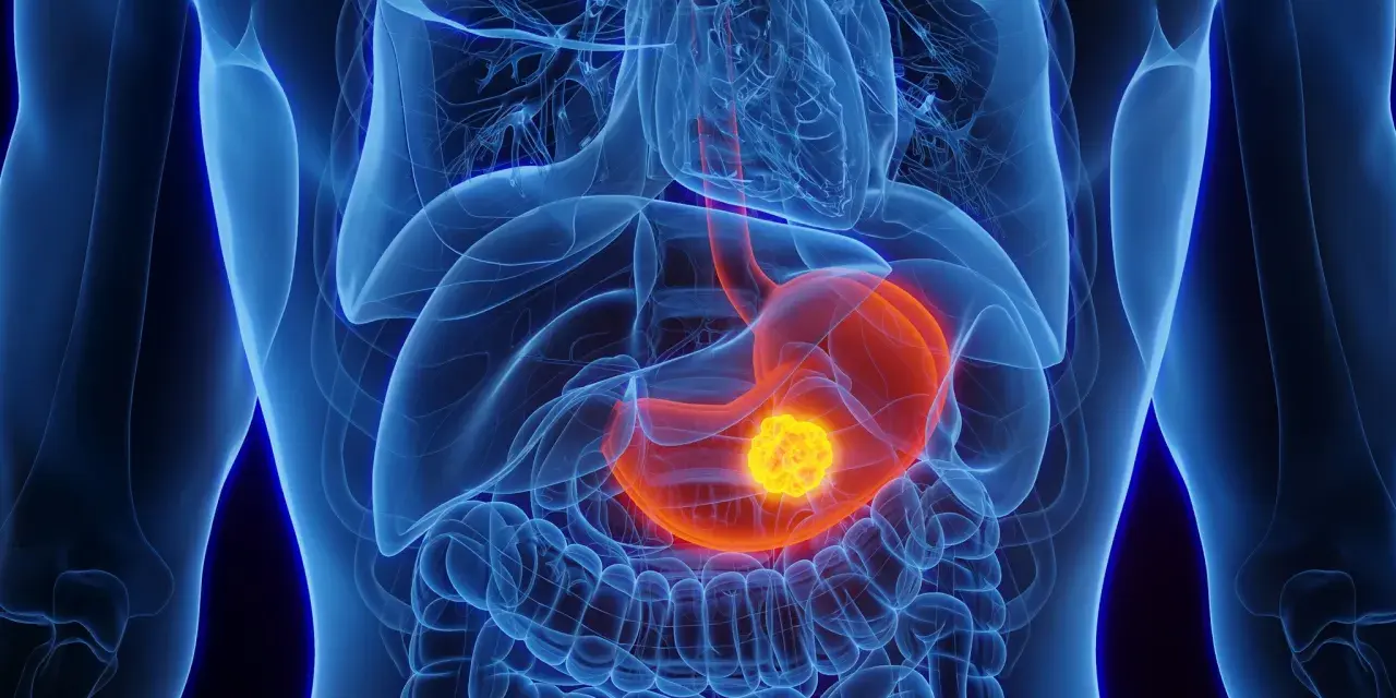 Anatomische Darstellung des menschlichen Oberkörpers mit hervorgehobenem Magen. Ein leuchtend gelber Tumor im Magen könnte ein Anzeichen für Magenkrebs sein.