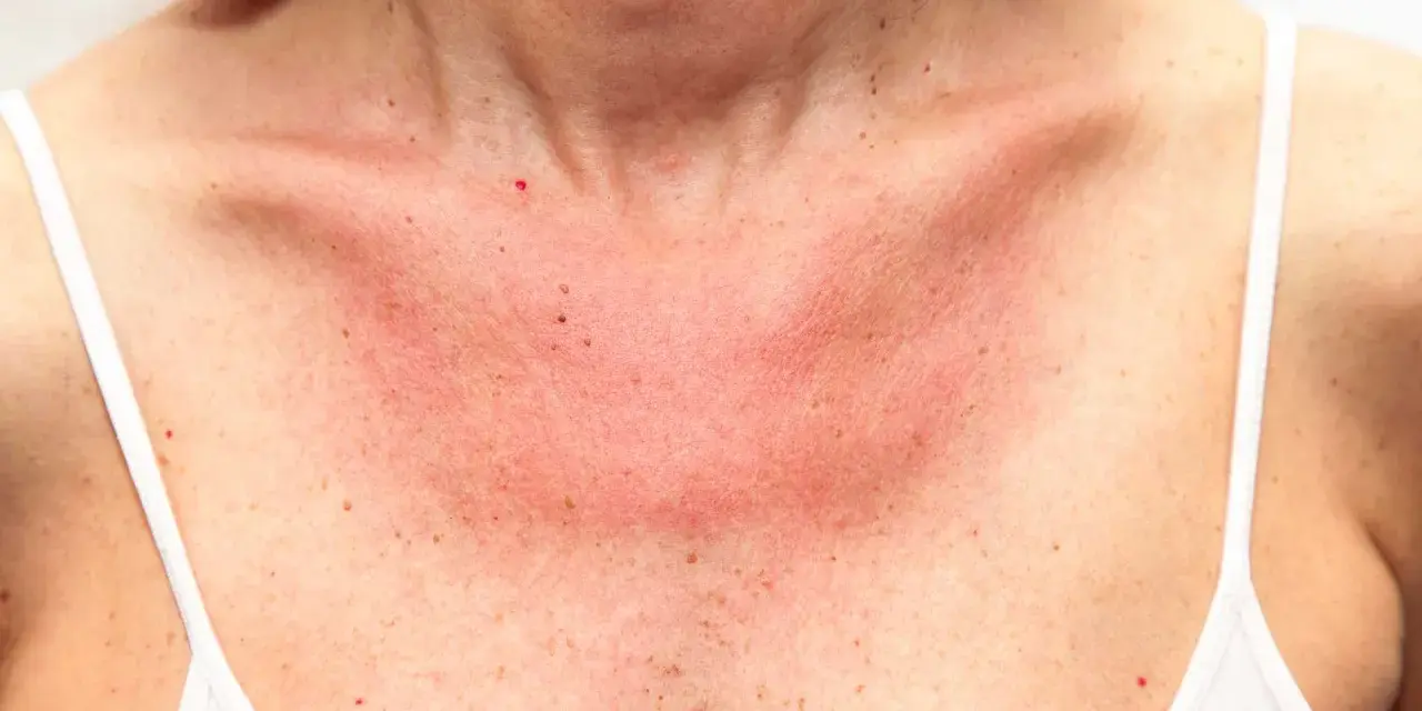 Här ser du hur soleksem kan se ut: röd, irriterad hud på bröstet och halsen, med små prickar.