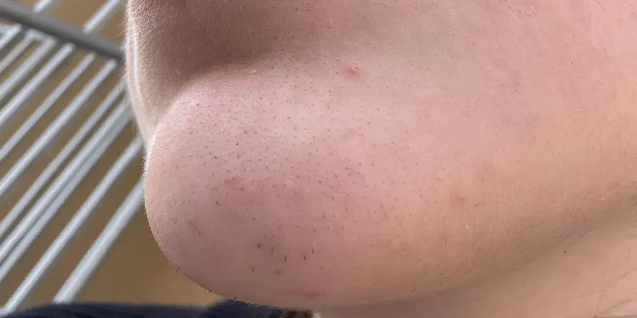 Primo piano del mento con pori visibili e alcuni punti neri. Si intravedono anche peli sottili e una piccola imperfezione.