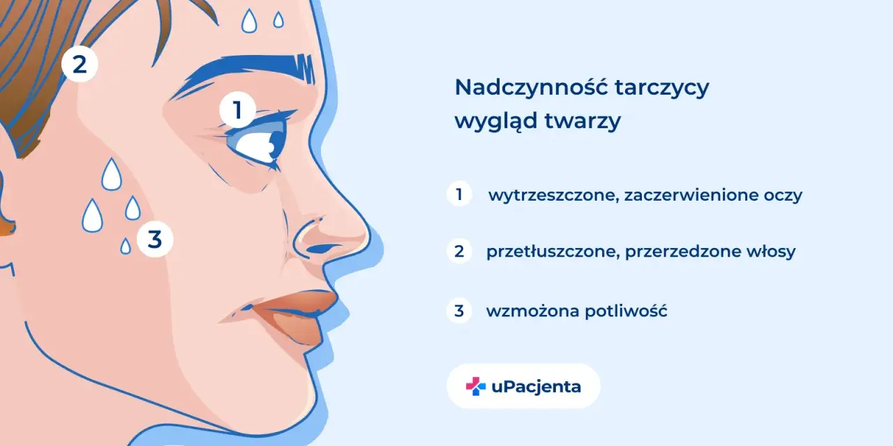 Nadczynność tarczycy objawia się wytrzeszczem oczu (1), przetłuszczonymi włosami (2) i wzmożoną potliwością (3).