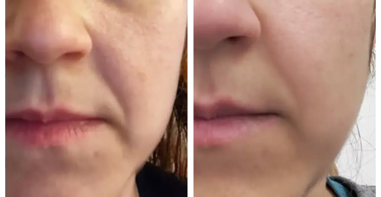 Comparaison avant/après : la peau semble plus lisse et les rides d'expression moins marquées grâce au bakuchiol.