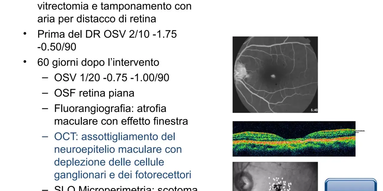 Caso 1: Maculopatia post-vitrectomia con bolla d'aria. Immagini OCT e SLO mostrano assottigliamento neuroepiteliale e scotoma.