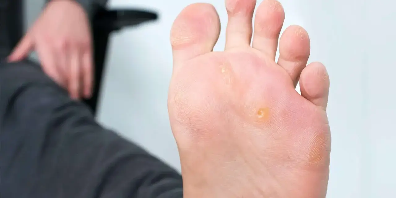 Gros plan sur un pied présentant un cors au pied infecté, visible sur la plante du pied, près des orteils.