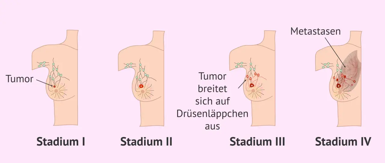 Illustrationen zeigen Stadien von Brustkrebs. Frühe Symptome wie ein Tumor werden sichtbar, bevor er sich ausbreitet. Spätere Stadien zeigen Metastasen.