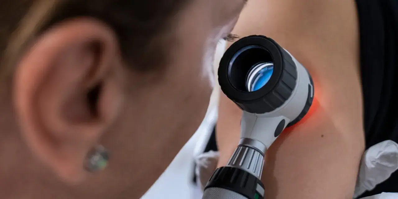 Dermatolog bada pieprzyk za pomocą dermatoskopu.