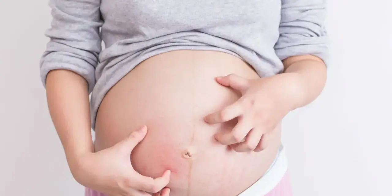 Kobieta w ciąży drapie brzuch z powodu swędzenia skóry.