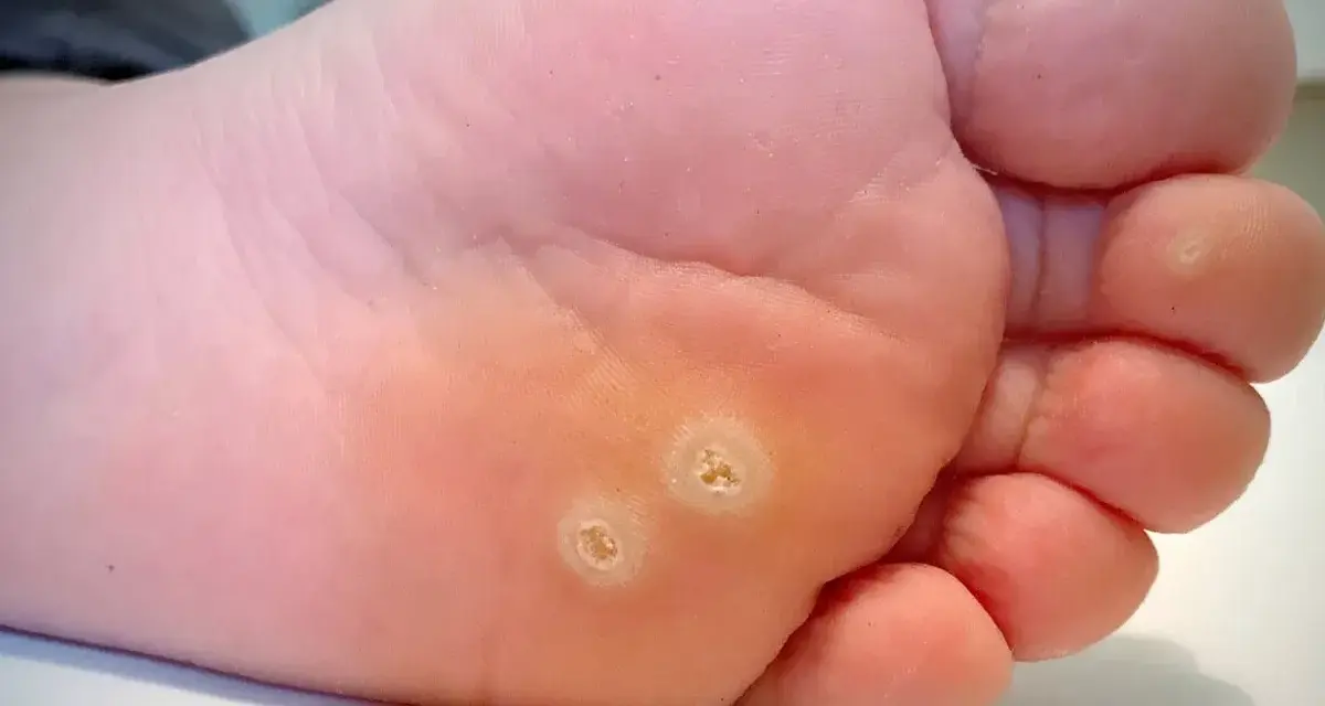 Gros plan sur la plante d'un pied, montrant deux verrues plantaires qui ne partent pas, avec une peau calleuse autour.