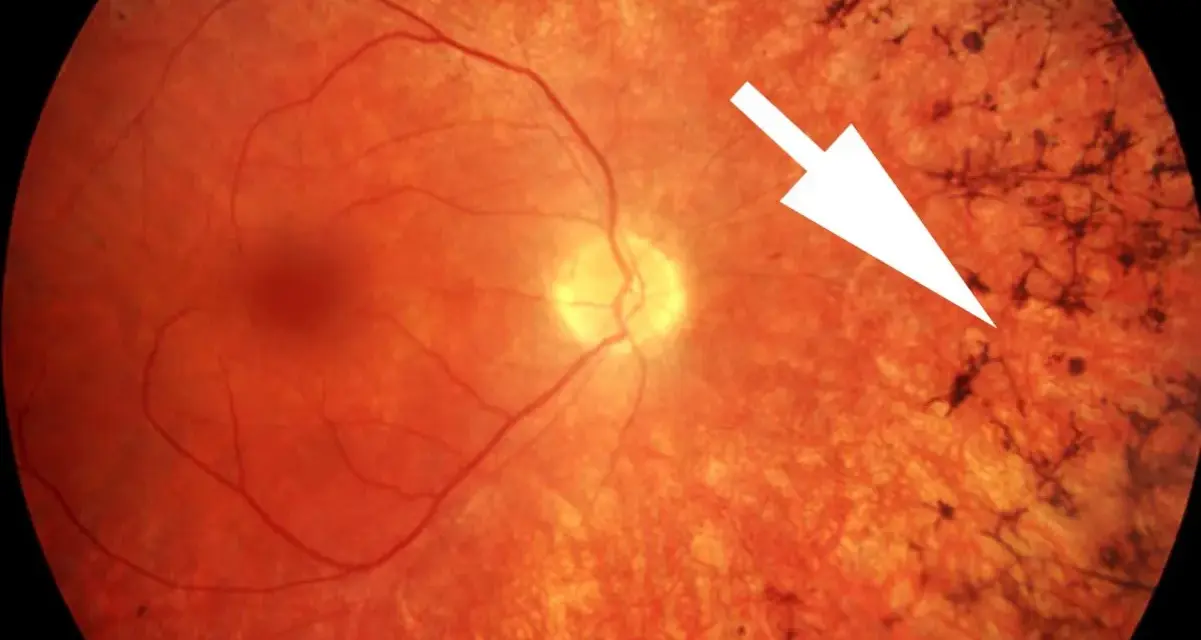 Retinite pigmentosa: sintomi visibili come depositi scuri sulla retina, indicati da una freccia bianca.