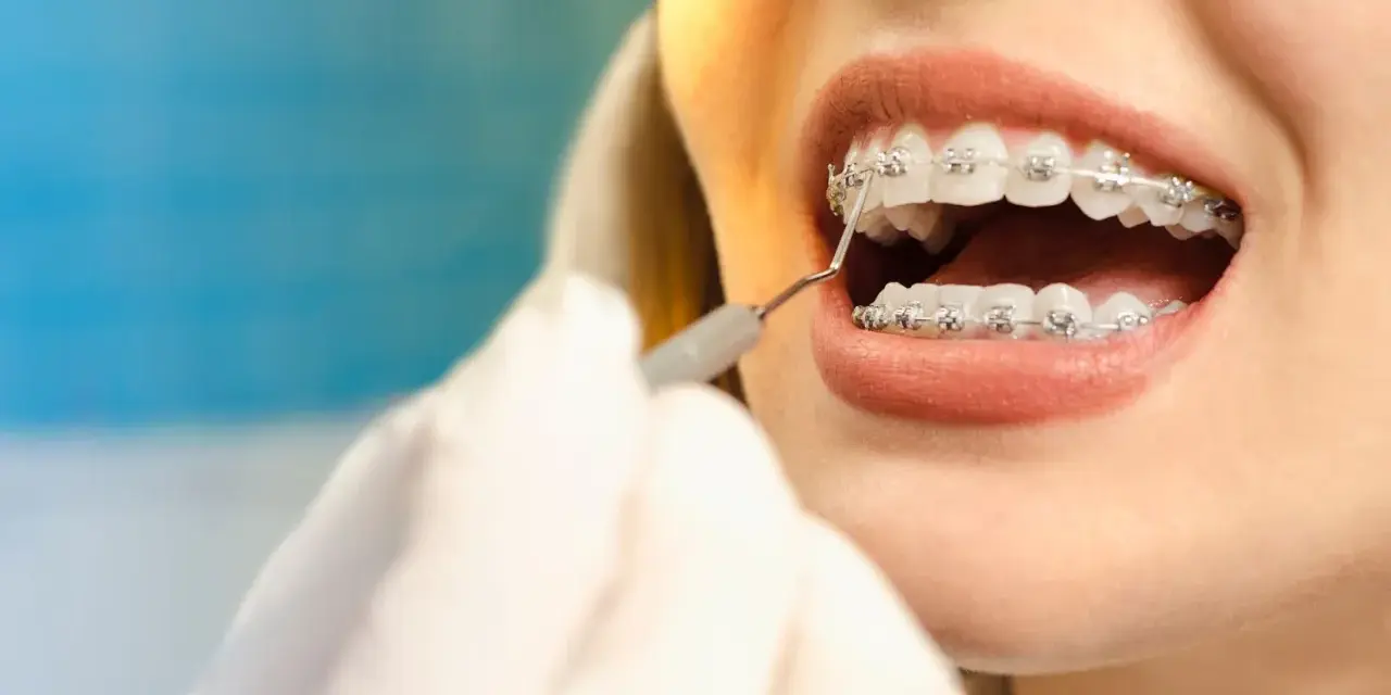 Zbliżenie na usta kobiety z aparatem ortodontycznym, badane przez dentystę.