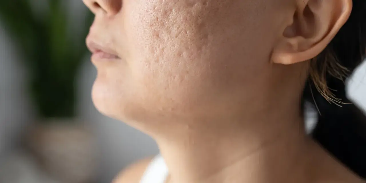 Primer plano de una mejilla con marcas de acné, mostrando la textura de la piel y la búsqueda de soluciones sobre como quitar marcas de acne.