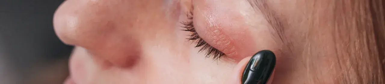 Nahaufnahme eines Auges mit roten Augenlidern, die auf eine Mangelerscheinung hindeuten. Eine dunkle Nagelspitze berührt sanft die Haut.