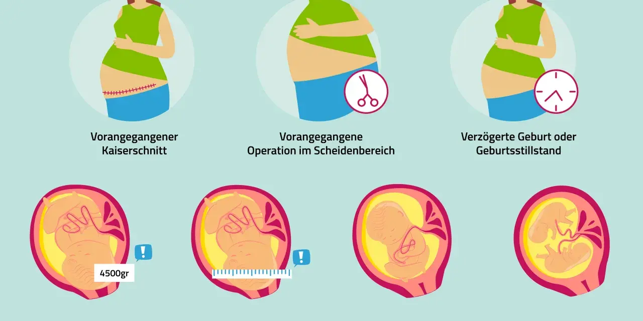 Bilder zum Kaiserschnitt-Ablauf: Narbe, OP im Scheidenbereich, verzögerte Geburt, zu schweres/großes Kind, Beckenendlage, Mehrlingsgeburt.