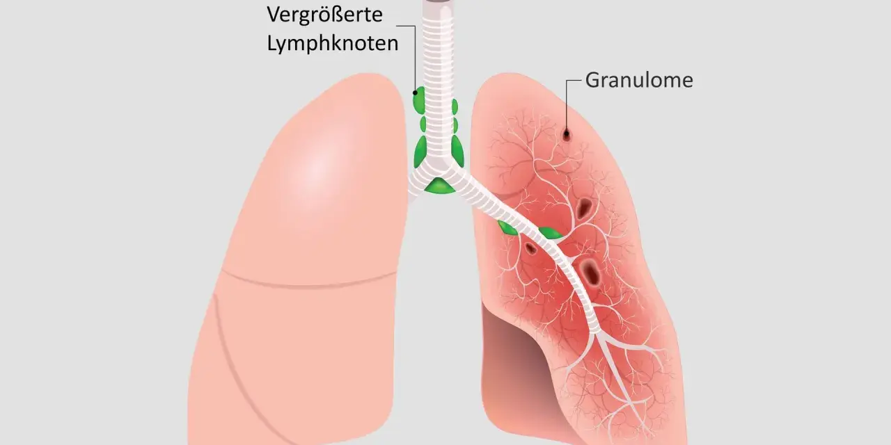 Lunge mit vergrößerten Lymphknoten und Granulomen, typische Sarkoidose-Symptome.