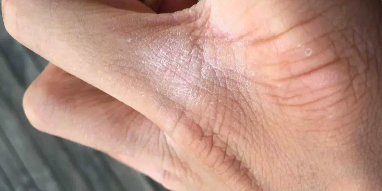 När huden är torr mellan fingrarna kan det kännas obekvämt. Här syns en närbild på en hand med torr hud och lite vita flingor.
