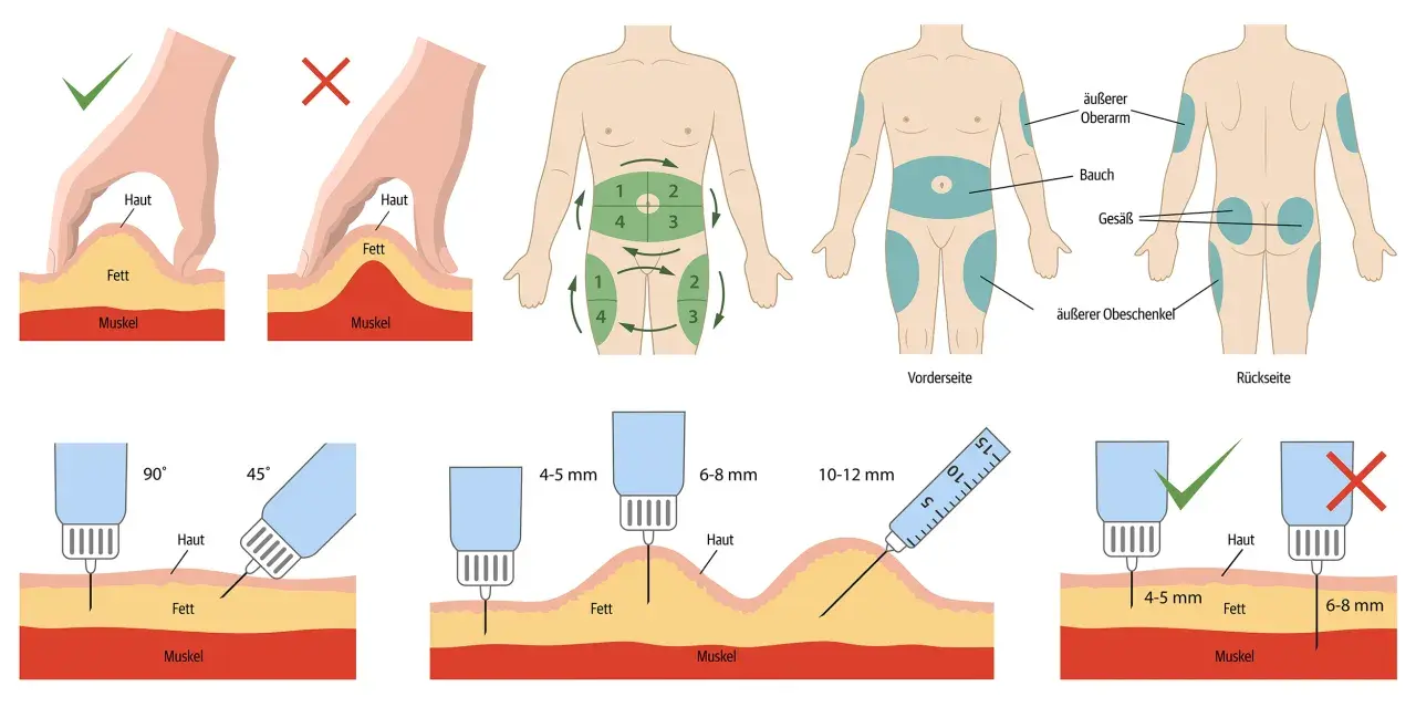 Anleitung: wie spritze ich Insulin richtig in den Oberschenkel. Zeigt Hautfalte, Injektionswinkel (90°/45°), Nadellänge und Körperstellen.