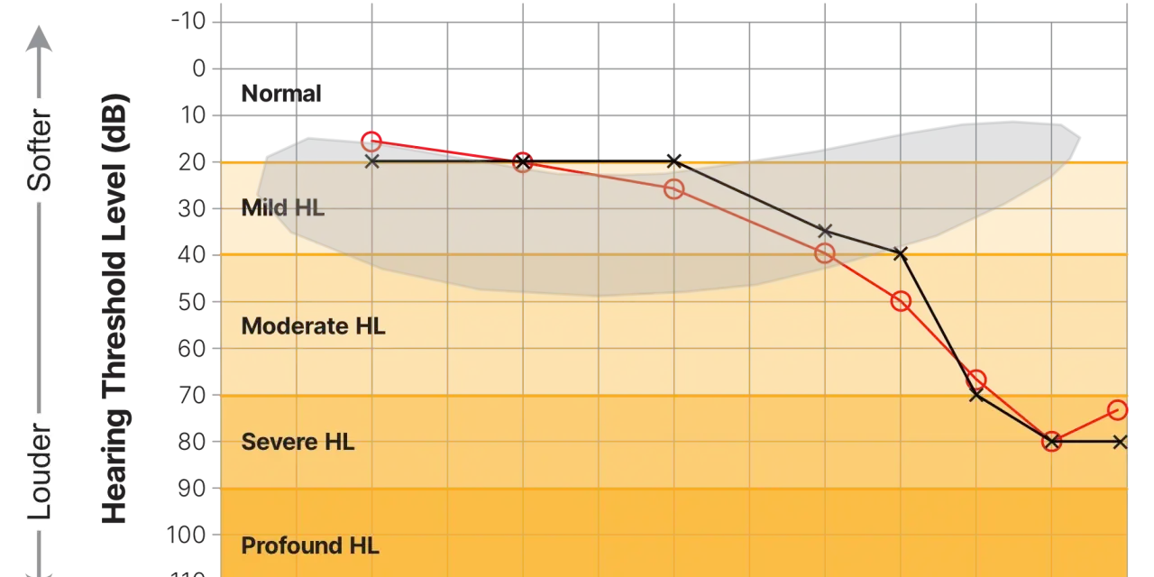 Graphique audiogramme montrant les seuils auditifs. On entend à partir de 0 dB. Les zones orange indiquent une perte auditive.