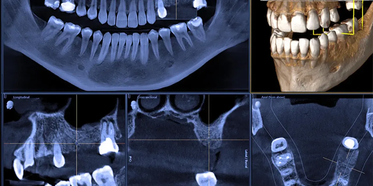 Badanie CBCT zębów: panorama, przekroje i wizualizacja 3D szczęki. Widoczne ubytki i korony.