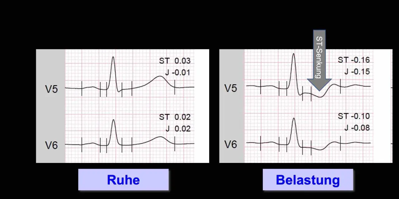 Vergleich von EKG-Aufzeichnungen in Ruhe und unter Belastung. Das Belastungs-EKG zeigt eine ST-Senkung, was auf pathologische Veränderungen hinweist.