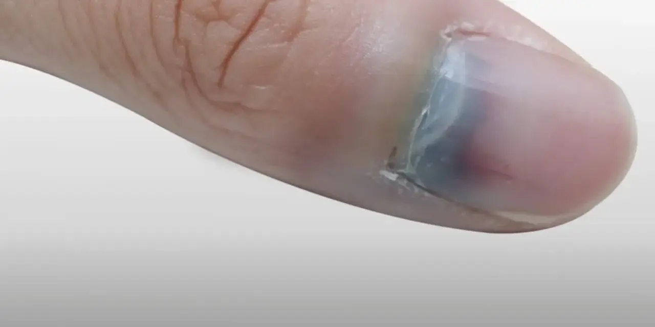 Gros plan sur un pouce avec un ongle bleu, signe d'un choc ou d'une ecchymose sous l'ongle.