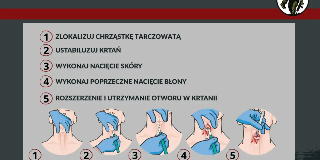 Ilustracja przedstawia procedurę konikotomii ratunkowej krok po kroku: lokalizacja chrząstki, stabilizacja krtani, nacięcie skóry i błony, rozszerzenie otworu.