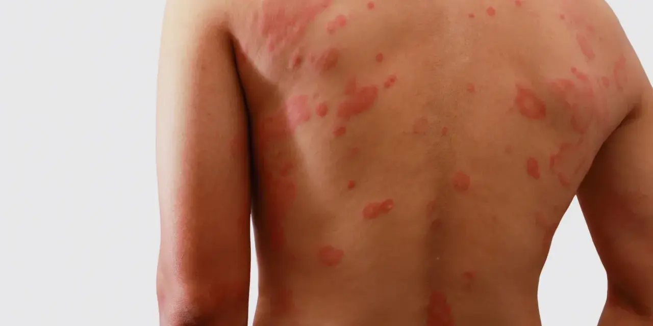 Plecy i ramię pokryte czerwonymi, swędzącymi zmianami skórnymi, mogącymi być objawem zespołu Stevensa-Johnsona.
