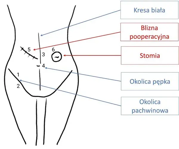 Przepuklina pachwinowa do jakiego lekarza? Kluczowe informacje dla pacjentów