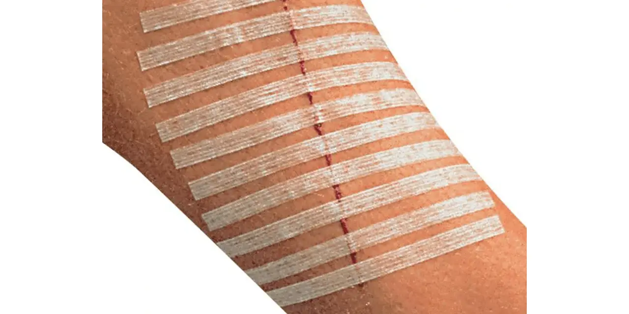 Rana na przedramieniu zabezpieczona plastrami zamiast szwów. Delikatne paski przytrzymują skórę, przyspieszając gojenie.