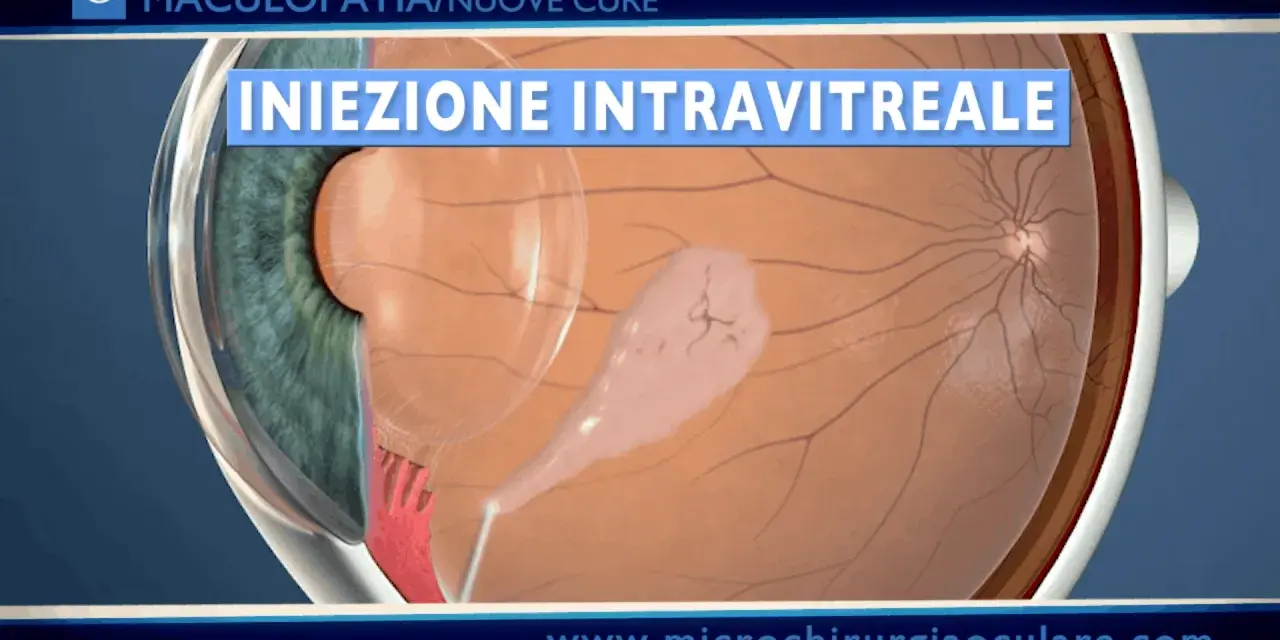 Iniezione intravitreale per trattare la maculopatia atrofica, mostrando una lesione sulla retina.