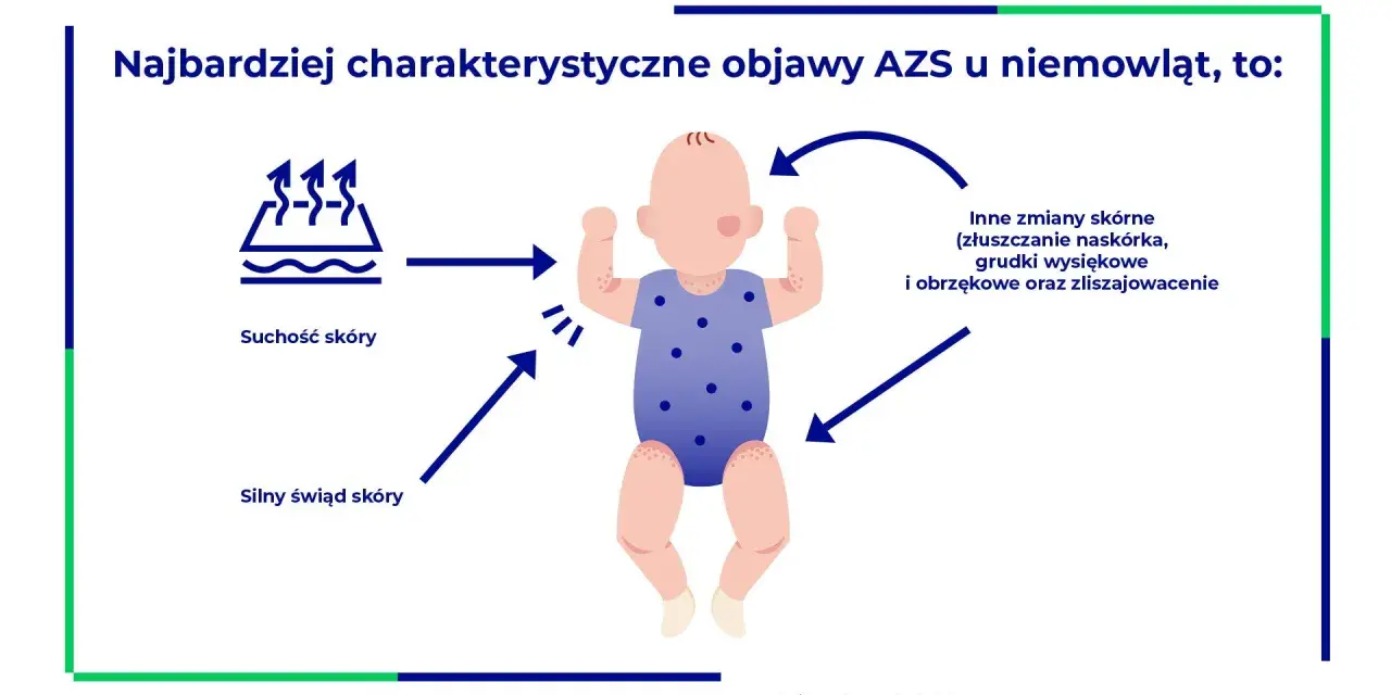 Objawy AZS u niemowląt: suchość i silny świąd skóry, inne zmiany skórne. Karmienie piersią to najlepszy sposób żywienia.