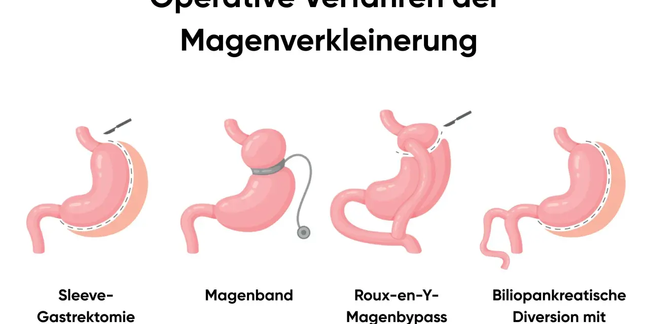 Illustrationen zeigen operative Verfahren zur Magenverkleinerung, darunter ein Magenbypass.