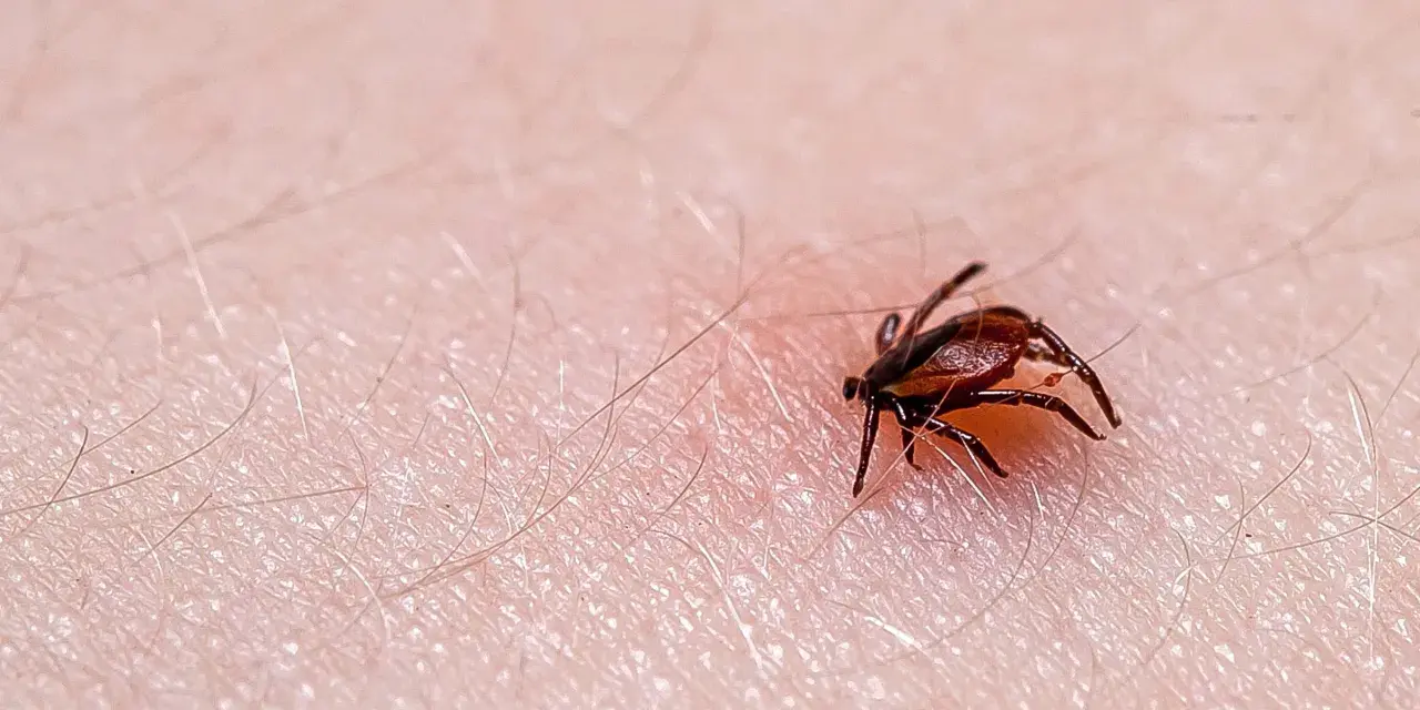 Makro zbliżenie na kleszcza wbitego w ludzką skórę, widoczne drobne włoski i tekstura naskórka.