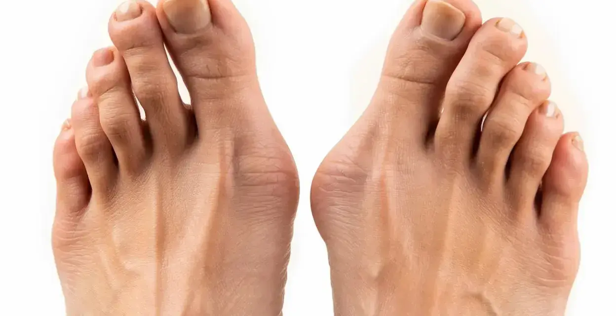 Två fötter med tydlig hallux valgus inflammation vid stortålederna.
