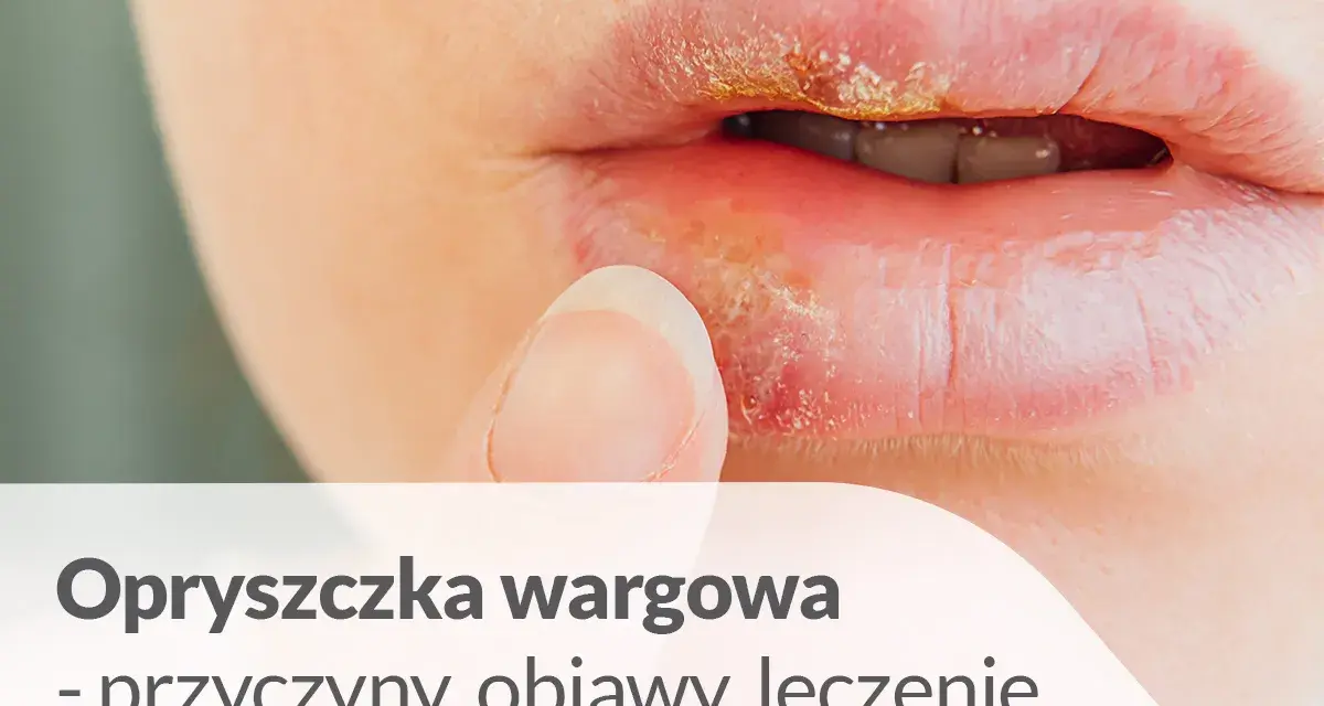 Zbliżenie na usta z widoczną opryszczką wargową w różnych fazach. Palec wskazujący dotyka dolnej wargi.