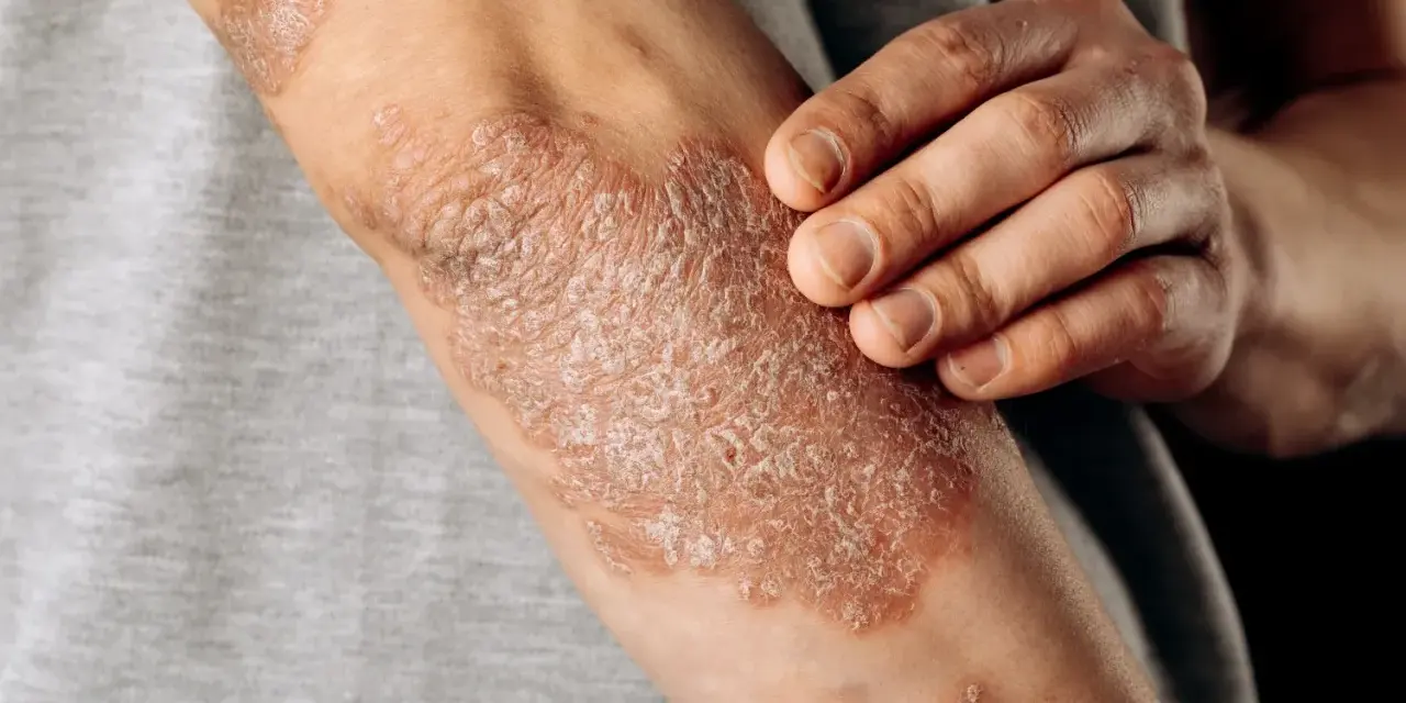 Psoriasis en los codos, con parches escamosos y enrojecidos. Una mano toca suavemente la piel afectada.