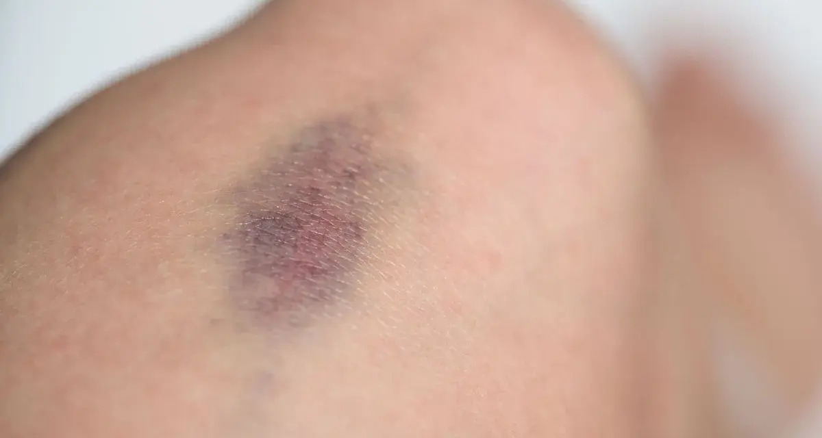 Nahaufnahme eines blauen Flecks am Bein, der auf eine mögliche Thrombose hindeutet.
