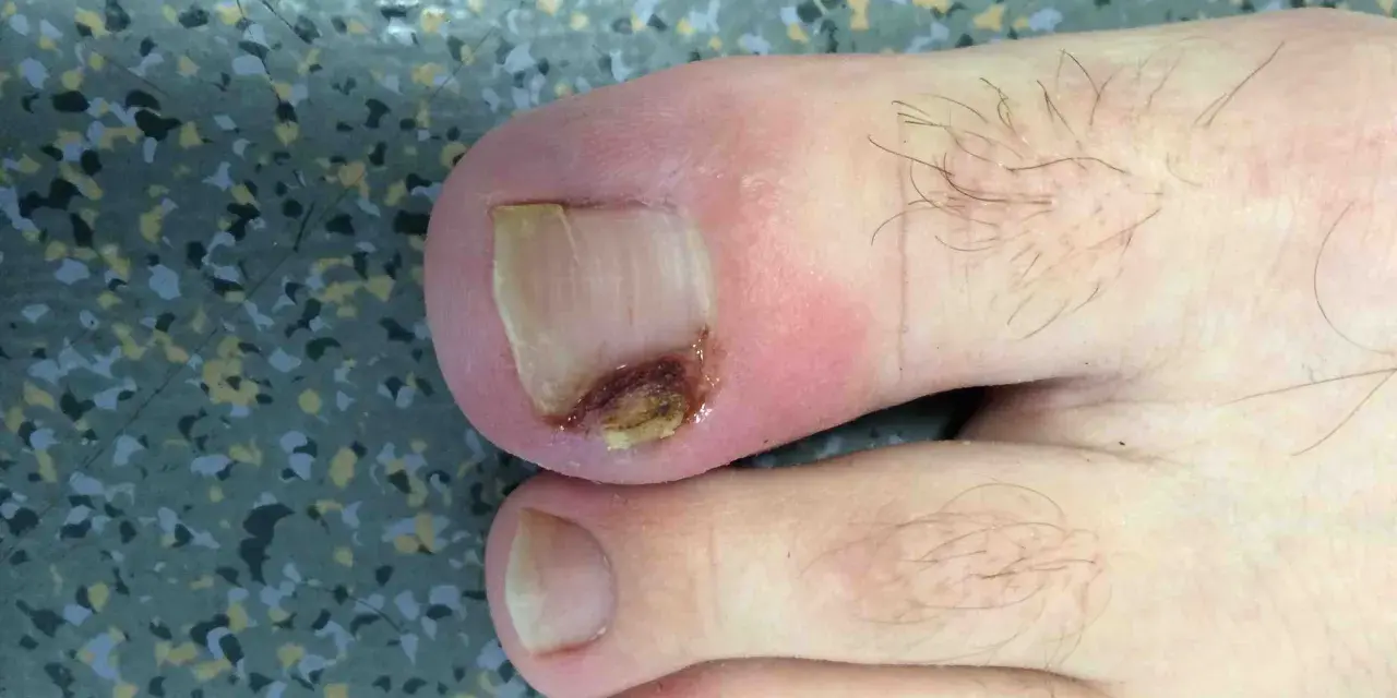 Gros plan sur un ongle de pied présentant un problème d'infection fongique, avec une partie de l'ongle décolorée et abîmée.