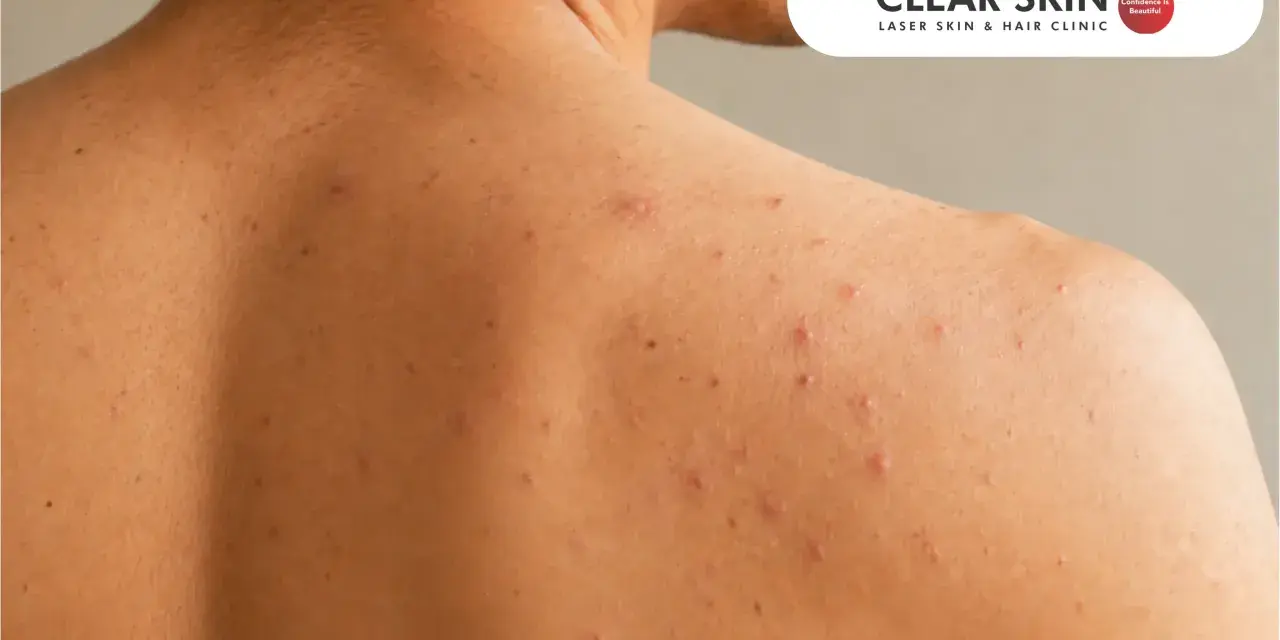 Close-up of shoulder acne. Learn how to get rid of shoulder acne overnight for clearer skin.