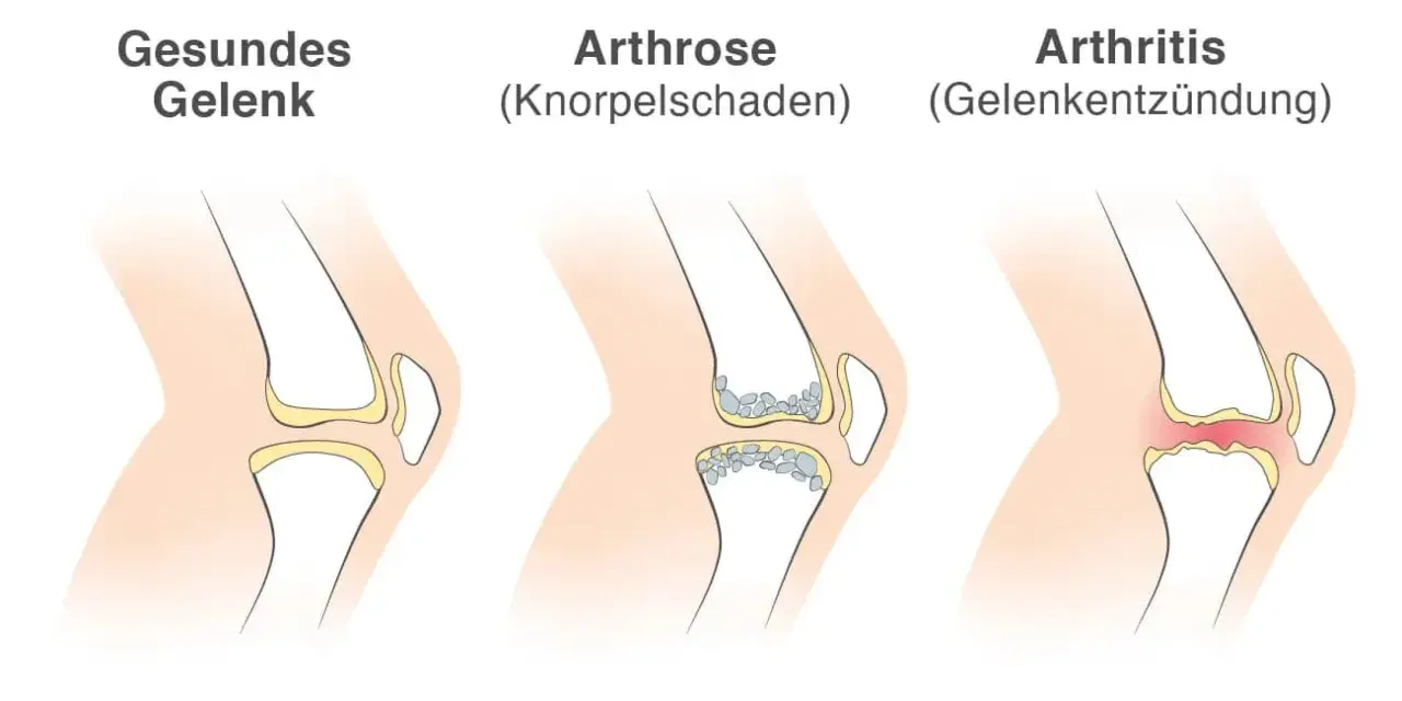 Vergleich von Gelenken: gesund, Arthrose (Knorpelschaden) und Arthritis (Gelenkentzündung). Arthritis zeigt eine Entzündung im Gelenk.