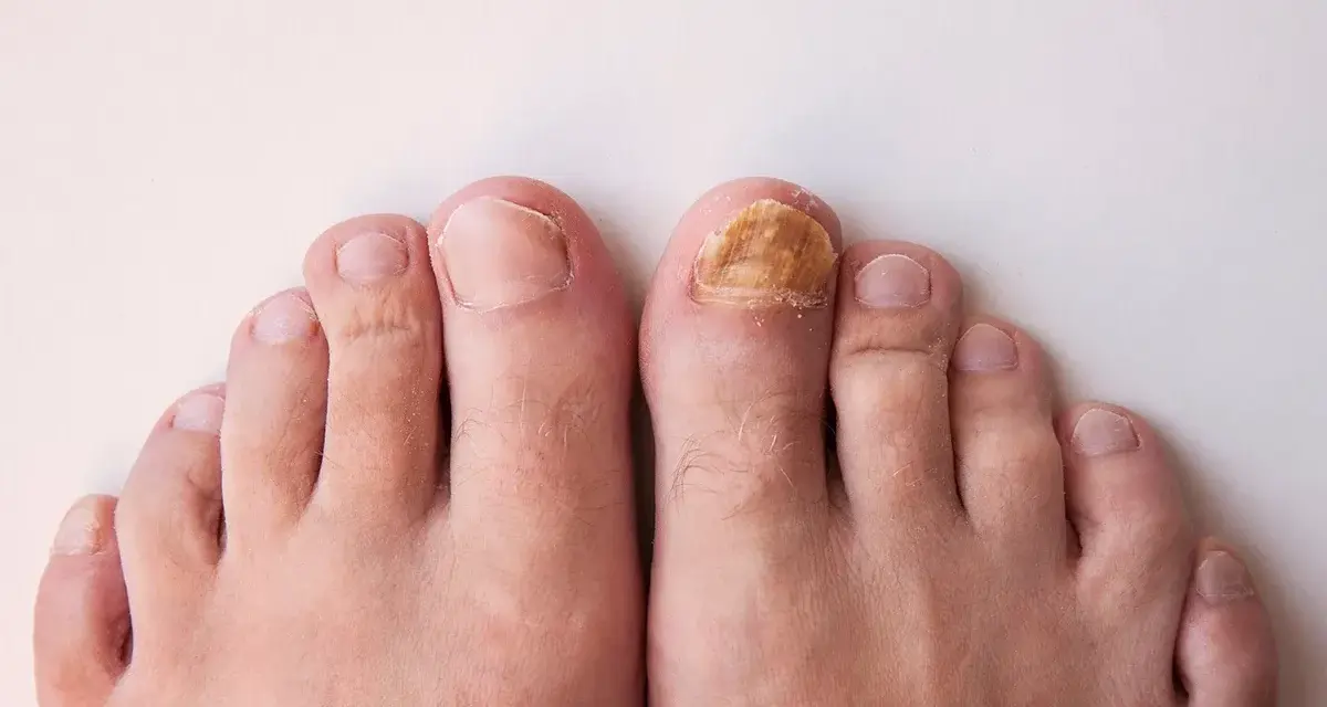 Gros plan sur des pieds, dont un ongle d'orteil atteint d'une mycose, illustrant un problème d'entretien ongles pieds.