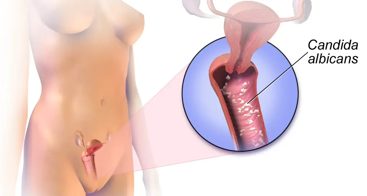 Illustration of a yeast infection in the vagina, showing Candida albicans.